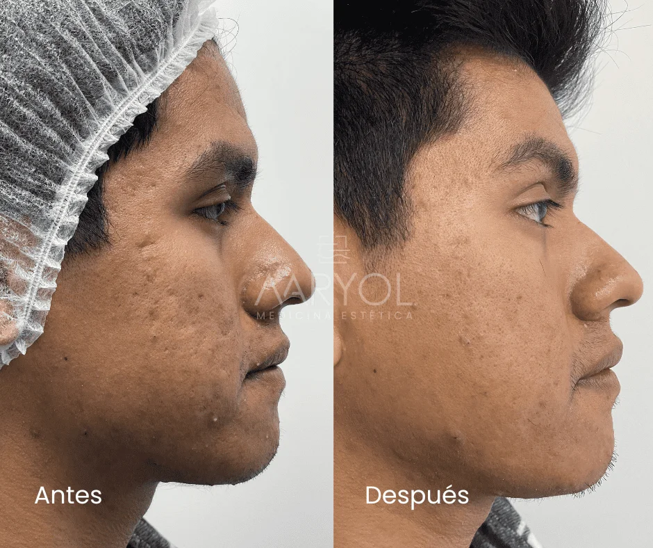 Antes y después Youtheal