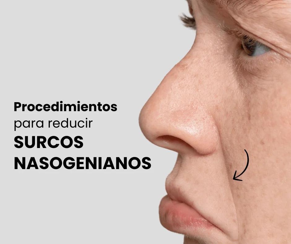 Tratamientos para surcos nasogenianos