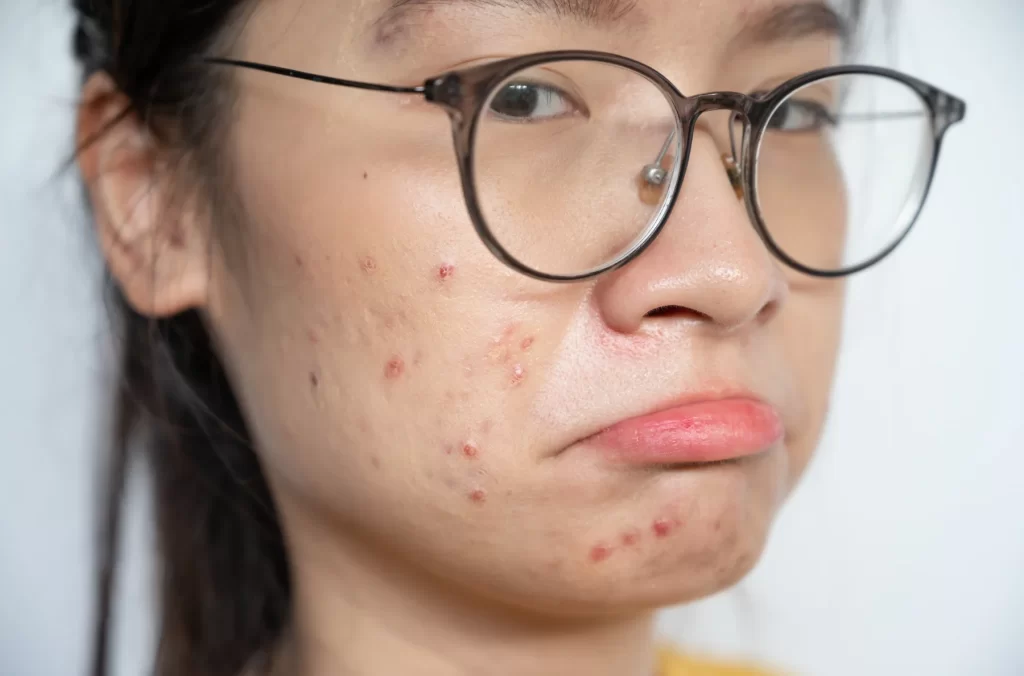 Bullying acne