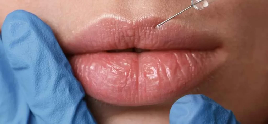Relleno de labios en Lima: precios, beneficios y resultados naturales