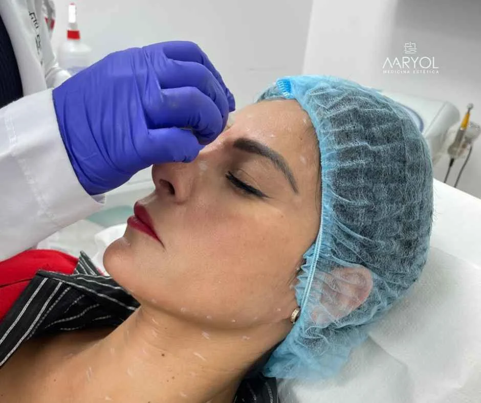 Beneficios de aplicarse toxina botulínica en el rostro