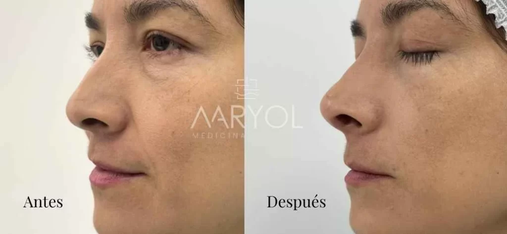 Rinomodelación con ácido hialurónico