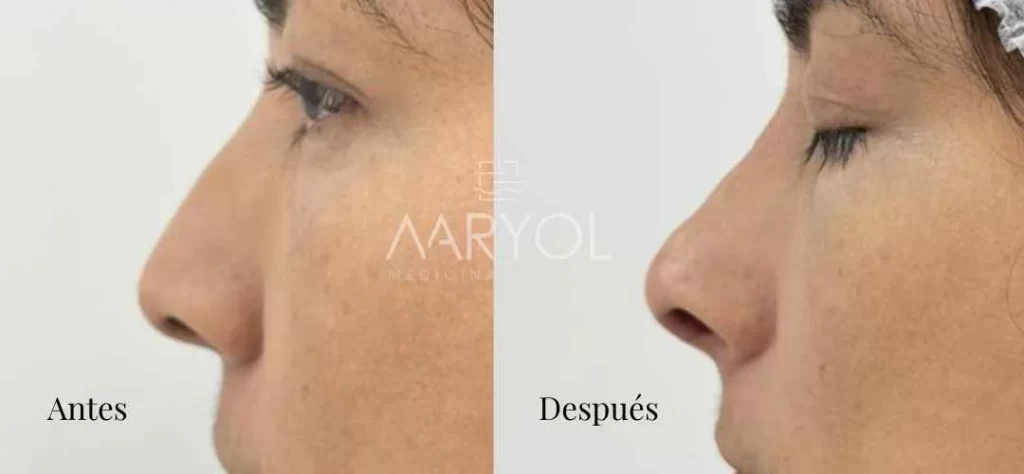 Antes y después Rinomodelación en Lima