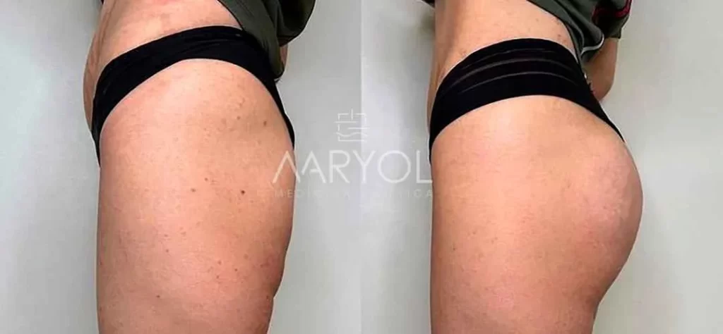 Antesw y después de aumento de glúteos con ácido hialurónico