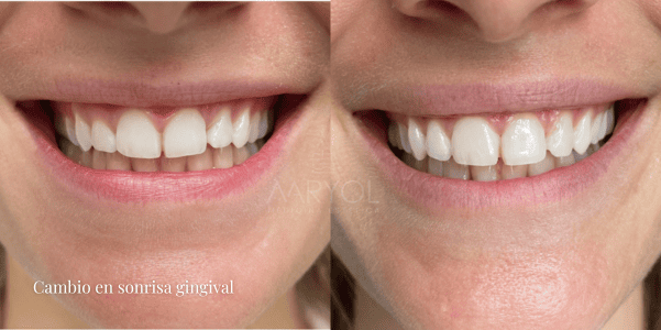 Sonrisa gingival antes y después con toxina botulínica
