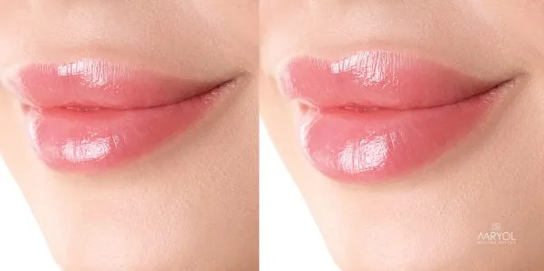 Cambio en labios con ácido hialurónico