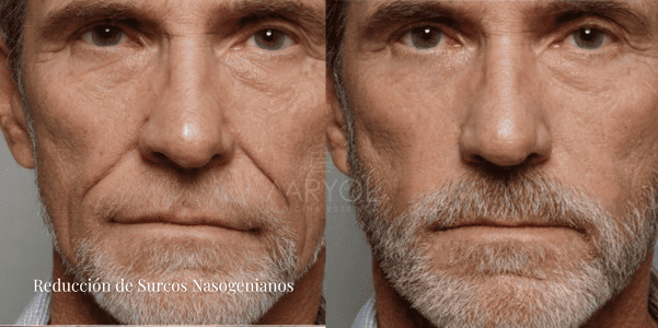 ¿Qué procedimientos reducen los surcos nasogenianos?