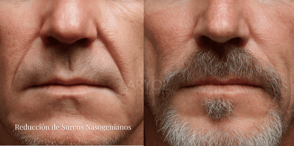Resultados naturales en antes y después de reducción de surcos nasogenianos