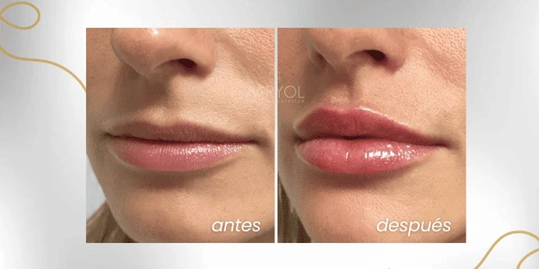 Aumento de labios antes y después: resultados reales