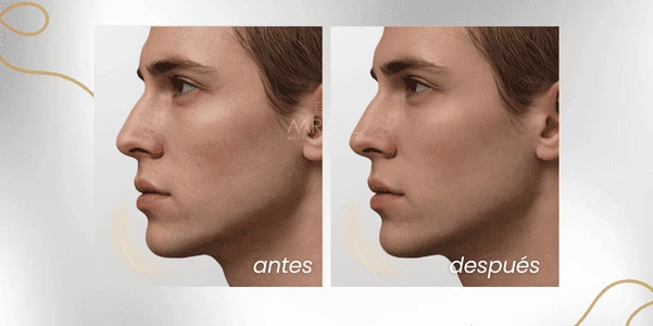 Antes y después aumento de mentón perfilamiento con hialurónico