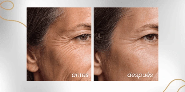 Antes y después disminución de arrugas alrededor de los ojos