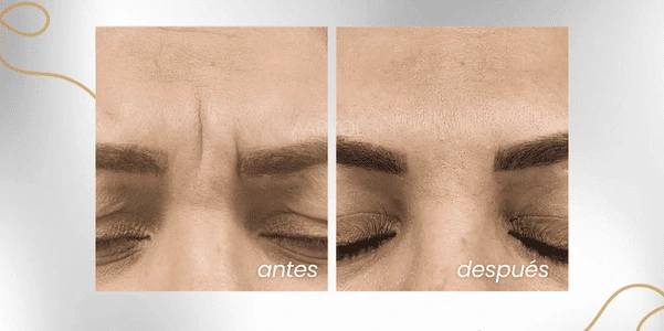 Antes y después en el entrecejo con toxina botulínica