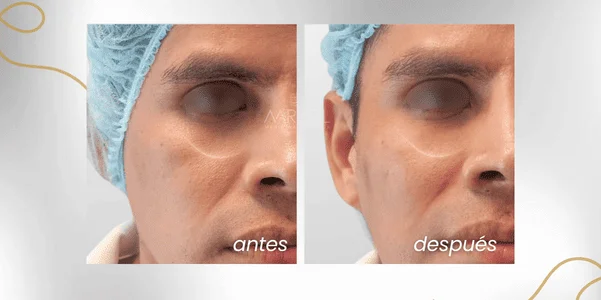 Antes y después de disminución de ojeras