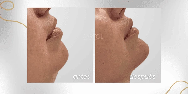 Antes y después en perfilamiento de mentón