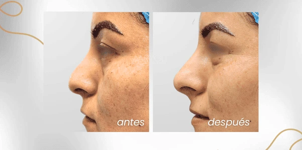Antes y después nariz caída