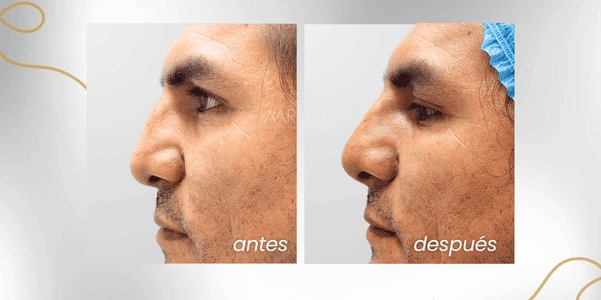 Antes y después rinomodelación para levantar la nariz chata o achatada