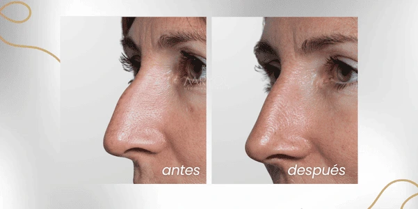Antes y después rinomodelación para la giba nasal con ácido hialurónico