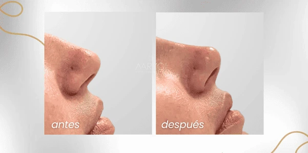 Antes y después elevar o levantar la punta de la nariz