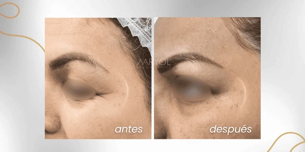 Antes y después toxina botulínica en patas de gallo